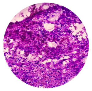 Non-Small Cell Lung Cancer (NSCLC)