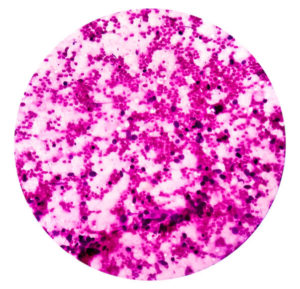 Small Cell Lung Cancer (SCLC)