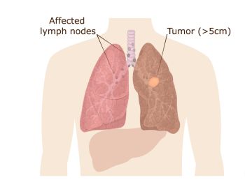 Diagram of stage 3 lung cancer tumors